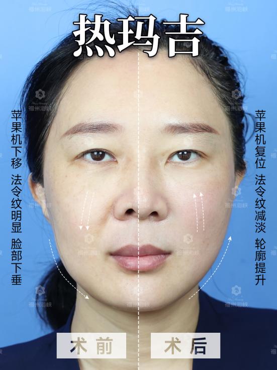 聚焦更好抗衰效果  福州海峡热玛吉「紧致提升地图」 新品发布